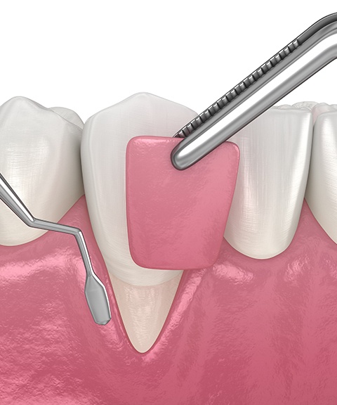 Animated gum grafting process