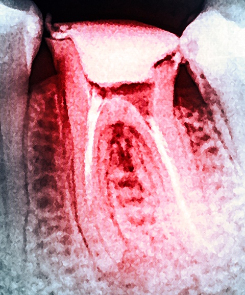 X-ray of damaged tooth prior to tooth extraction