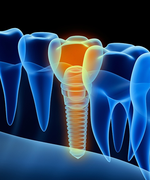 Animated 3 D model of dental implant supported dental crown