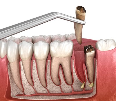 3D render of a complex tooth extraction