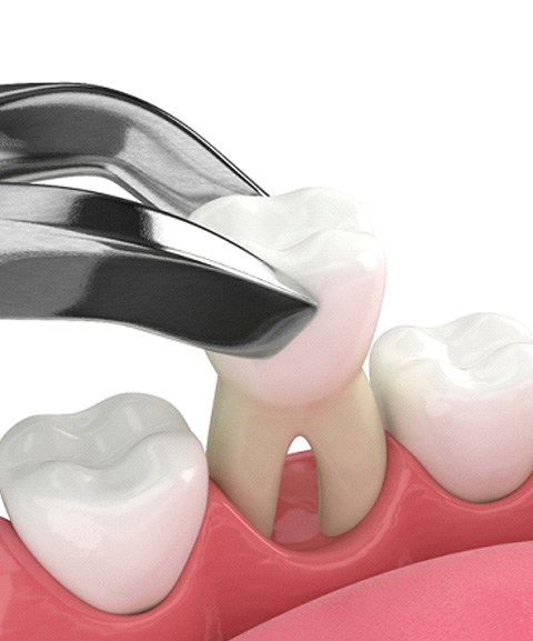 Illustration of a tooth extraction in Mayfield Heights, OH