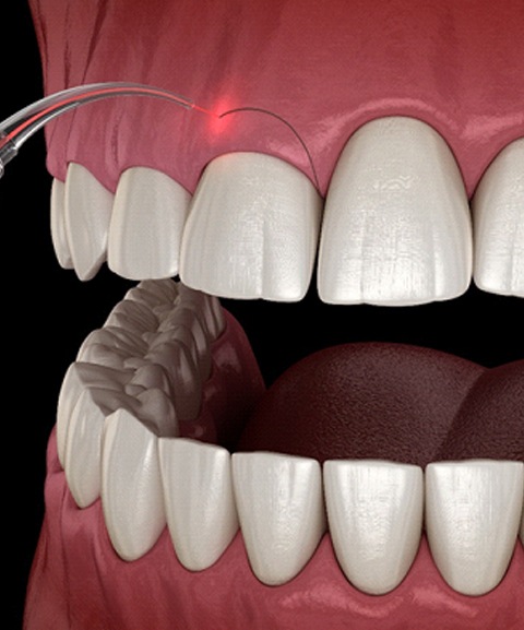 Illustration of laser being used to perform gum recontouring