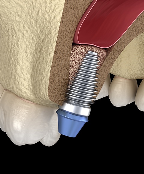 Animated grafted bone tissue around dental implant post