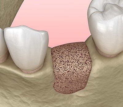 Digital illustration of bone regeneration in Mayfield Heights for dental implants