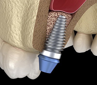 Digital illustration of bone grafting in Mayfield Heights for dental implants