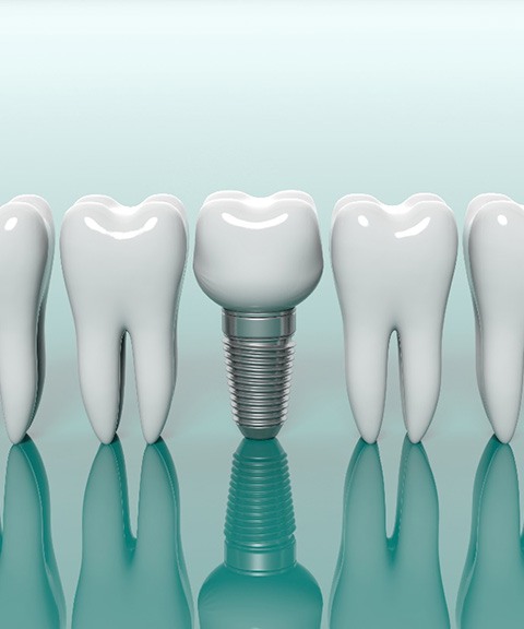 Model dental implant in Mayfield Heights with model teeth for comparison