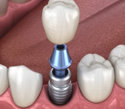 Animated dental implant supported dental crown placement