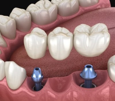 Animated dental implant supported fixed bridge