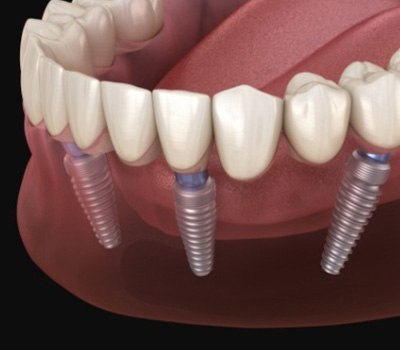 Animated dental implant supported denture