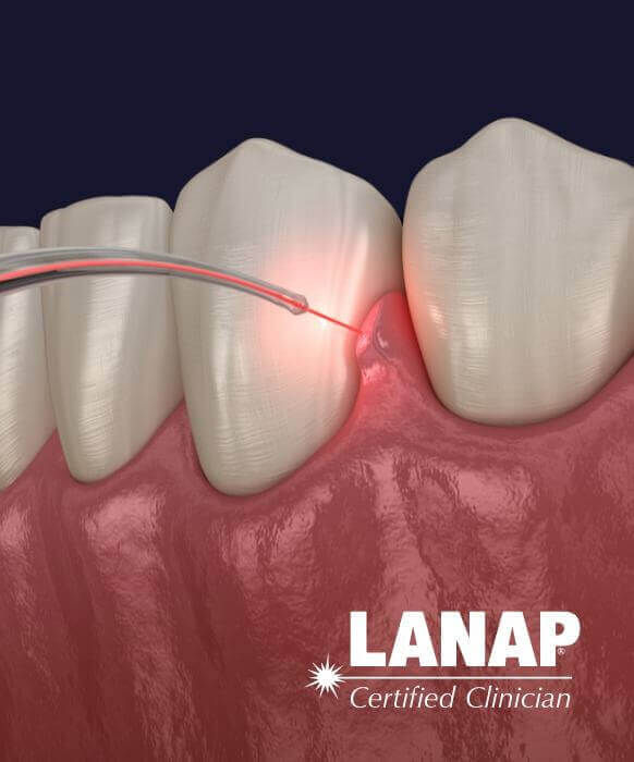 Animated laser periodontal treatment process
