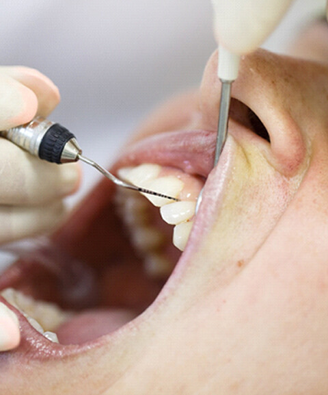 Measuring periodontal pocket depth before osseous surgery