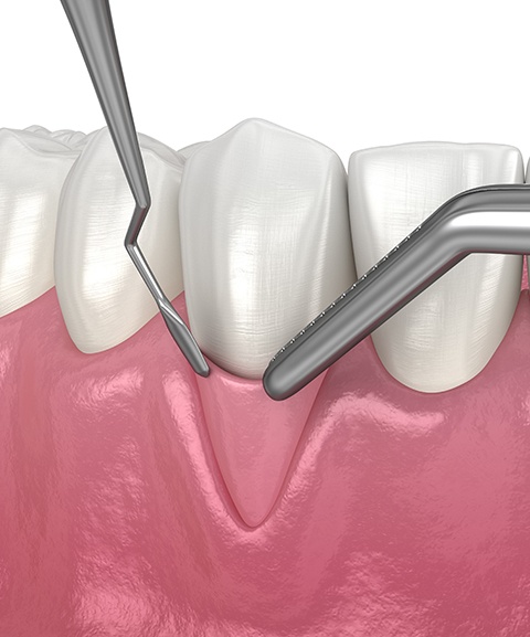 Patient receiving non surgical periodontal therapy