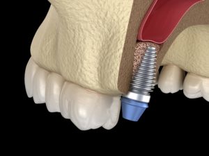 Model of dental implant after bone graft in Mayfield Heights.