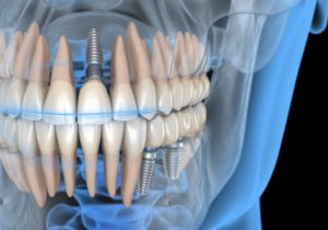 Illustration of three dental implants in Mayfield Heights in jawbone