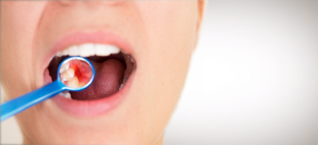 Dental mirror showing inflamed gums