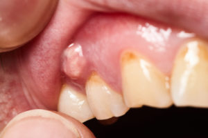 Close up of overgrown gums