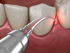 Illustration of laser being used to treat gums