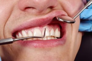 Patient at the dentist having their gums inspected.