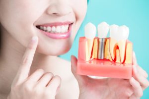 closeup of dental implants in Mayfield Heights