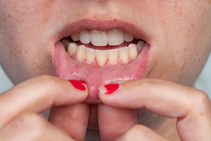 Pulling down lip to show signs of gum recession