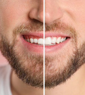 Close-up of smile before and after gum recontouring