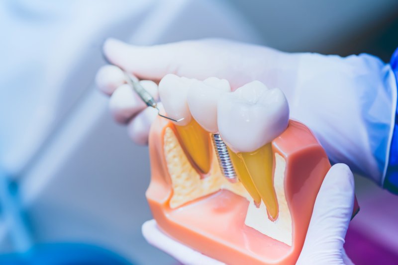 A closeup of a dental implant model