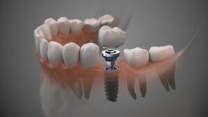 Animated model of dental implant.